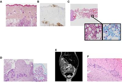 Acquired and Innate Immunity Impairment and Severe Disseminated Mycobacterium genavense Infection in a Patient With a NF-κB1 Deficiency